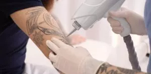 August 14: National Tattoo Removal Day